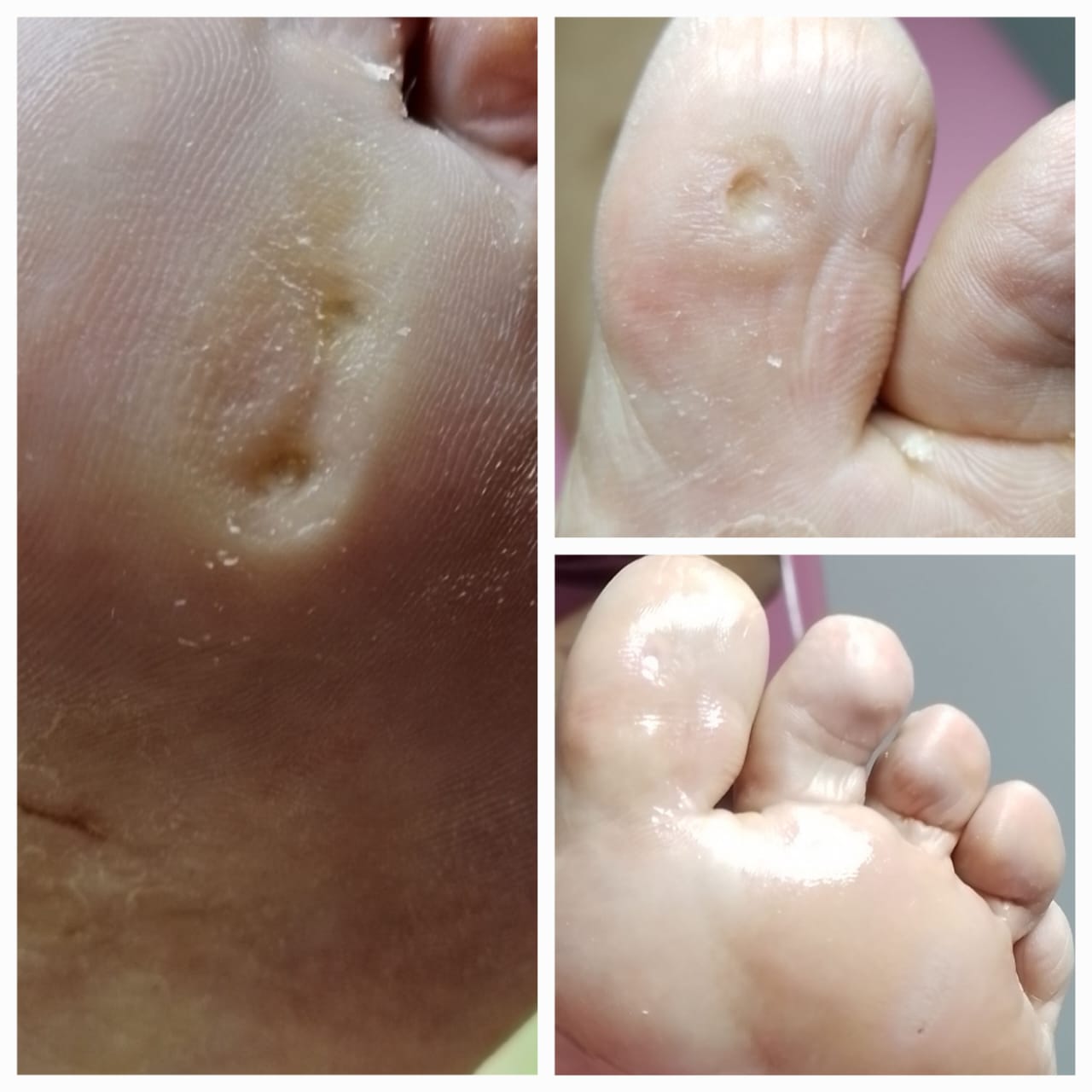 Tratamento de olho de peixe (clavus plantaris)