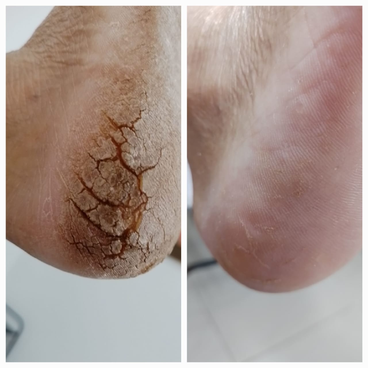 Tratamento de calosidade (hiperqueratose plantar)