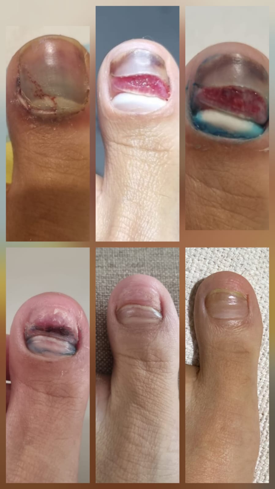 Tratamento de unha encravada (onicocriptose)